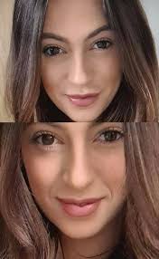 Absolutely thrilled to treat Lucy Dennis again in clinic. My duty of care  to each patient means it's so important I get it right & that wellbeing is  enhanced. Lucy wanted a