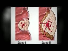 Learn about the signs and symptoms of pancreatic cancer, including, but not limited to: Copy Of Cancer Of Stomach Lessons Blendspace