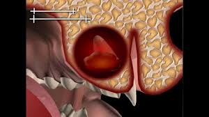 Image result for Cystostemon