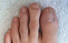 This can cause increased redness, pain and swelling to the skin on the side of the nail. Ingrown Toenail Procedures Ottawa Foot Clinic