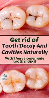 Cavities result as an imbalance of these cycles toward more mineral loss from your enamel. How To Heal Tooth Decay And Reverse Cavities Naturally Tooth Decay Remedies Teeth Health Tooth Decay