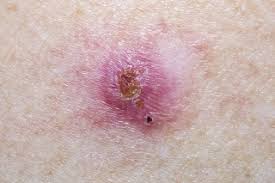 Find out how to spot the early signs of skin cancer. Common Skin Cancer Can Signal Increased Risk Of Other Cancers News Center Stanford Medicine