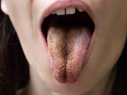 Check spelling or type a new query. 7 Warna Lidah Yang Harus Anda Waspadai Bisa Jadi Tanda Penyakit Berbahaya Okezone Lifestyle