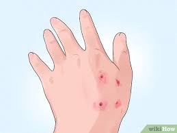 · the first symptoms of rabies may be nonspecific and include lethargy, fever, vomiting, and anorexia. How To Identify Rabies In Humans 11 Steps With Pictures