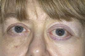 However, medical treatment alone will not necessarily reverse the protrusion of the eyes. Proptosis Augenkrankheiten Msd Manual Profi Ausgabe