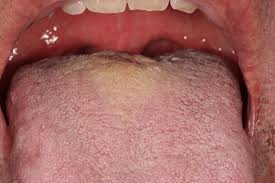 Image result for papillomavirus tongue)