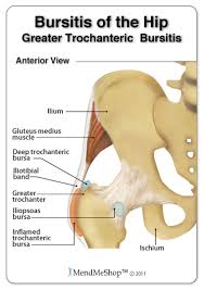 Side hip pain was often diagnosed as bursitis. Hip Bursitis Information And Treatments