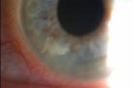 Image result for Keratitis