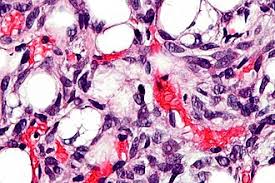 Image result for Liposarcoma
