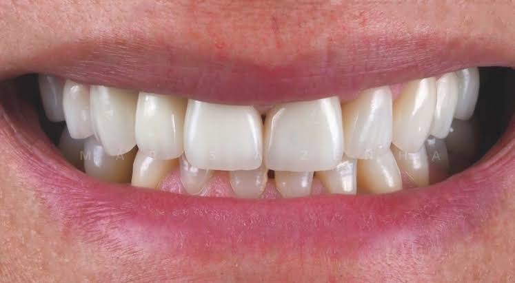 Dental Veneers - Consiga um Soriso Estético • Marisa Zenha