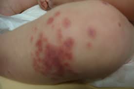 Steroid purpura with skin atrophy can result from topically or systemically administered corticosteroids. Derm Dx A 10 Month Old Boy With Purpuric Plaques Clinical Advisor