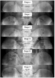 Image result for Risser Sign