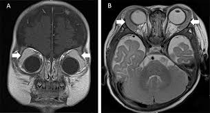 Image result for Dacryoadenitis