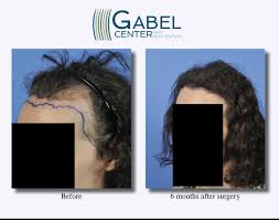 I wasn't always super accurate, but oh well. Watch A Patient S Real Time Growth After 3439 Grafts Gabel Center