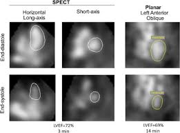Image result for Nuclear Ventriculogram