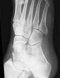 For a stress fracture of the foot, the best treatment is to give the foot time to heal by resting as much as possible. The Patterns Of Injury And Management Of Cuboid Fractures The Bone Joint Journal