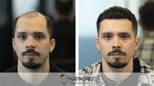 Protesi capelli parziale = base non oltre 10x10cm protesi capelli standard = base . Protesi Capelli Infoltimento Capelli Hair Again