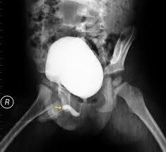 Image result for Voiding Cystourethrogram