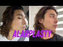 ALARPLASTY at The Icon Clinic with Doc Yappy