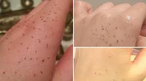 Cleansing your thighs cleansing is the best place to start when wanting to eradicate these unsightly inner thigh blackheads. Skin Gritting Is Blackhead Removal Like You Ve Never Seen Before Glamour