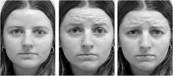 Brain activation during processing of genuine facial emotion in depression:  Preliminary findings