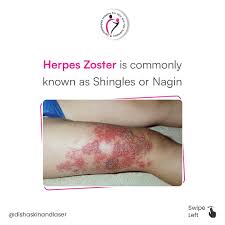 Image result for Varicella zoster on human skin