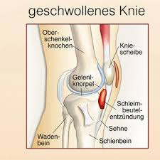 Kniebeschwerden an der innenseite bezeichnet der orthopäde auch als medialen knieschmerz. Welche Knieverletzungen Gibt Es Und Wie Werden Sie Behandelt
