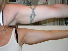 Aug 04, 2021 · make a homemade tattoo removal cream. 10 Things You Need To Know About Laser Tattoo Removal Wild Tattoo Art