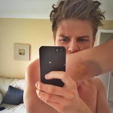 Lawson star Joel Peat shares Instagram picture of bite from female fan at  Gibraltar gig