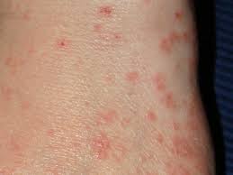 Image result for scabies human bites