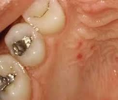 Image result for Physical injury red spots roof of mouth