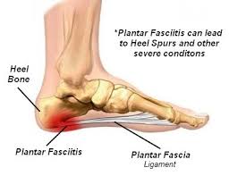 Pin On Plantar Fasciitis