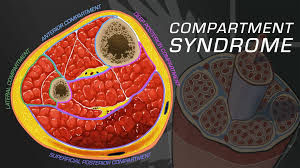 Image result for Compartment Syndrome