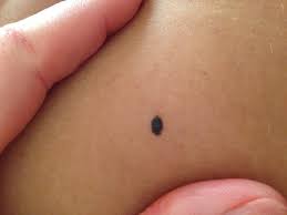 Caracteristicile de baza ale acestui tip de alunite sunt asimetria. Copilul TÄƒu Are AluniÈ›e Cand Este Cazul SÄƒ Mergi La Dermatolog Exquis