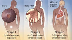 Image result for syphilis symptoms