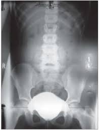 Image result for Voiding Cystourethrogram