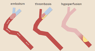 Image result for Stroke Pathophysiology