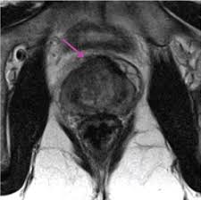 Whether you or someone y. Anterior Prostatic Tumours Are Difficult To Diagnose Without Mri Ecancer