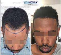 Extraction of grafts from the donor area. Is The Fue Technique Efficient To Transplant Afro Frizzy Hair