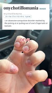 Image result for Onychotillomania feet