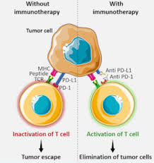 Image result for Merkel Cell Carcinoma