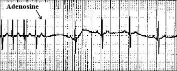 That could be one sign of a condition called supraventricular tachycardia, or svt. Neonatal Supraventricular Tachycardia Svt American Academy Of Pediatrics