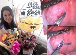 Histerektomi adalah proses membuang rahim melalui kaedah pembedahan. Alhamdulillah Berjaya Kini Proses Untuk Pastikan Jahitan Dalam Rahim Sembuh Dj Lin Kongsi Video Bedah Buang Fibroid Dalam Rahimnya Media Hiburan