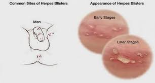 Image result for penis mycosis symptoms