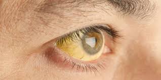 Antara imbalan tidak dijangka apabila mata kanan berkedip sebelah kanan termasuk akan mendapat wang atau keuntungan selain berita baik. Ketahui Penyebab Mata Kedutan Sebelah Kanan Secara Medis Bisa Jadi Gejala Penyakit Merdeka Com