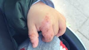 Typisch sind kleine rote punkte und bläschen vor allem im bereich der füsse, hände und im mundraum. Hand Mund Fuss Krankheit Beim Kind Erkennen Und Behandeln