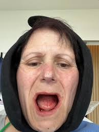 I just explanted with Dr. Philip J. Straka, MD, FACS in Houston. I drove  from Alabama to see him. I know everyone is different but let me just say,  I have had