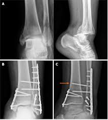 Acute syndesmotic injuries in ankle fractures: From diagnosis to ...