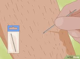 Pimple popper demonstrates how to remove an ingrown hair online, article, story, explanation, suggestion. Easy Ways To Spot Ingrown Hairs 9 Steps With Pictures Wikihow