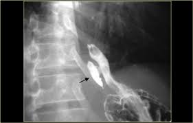 A progress report on observer agreement. The Radiology Assistant Esophagus I Anatomy Rings Inflammation